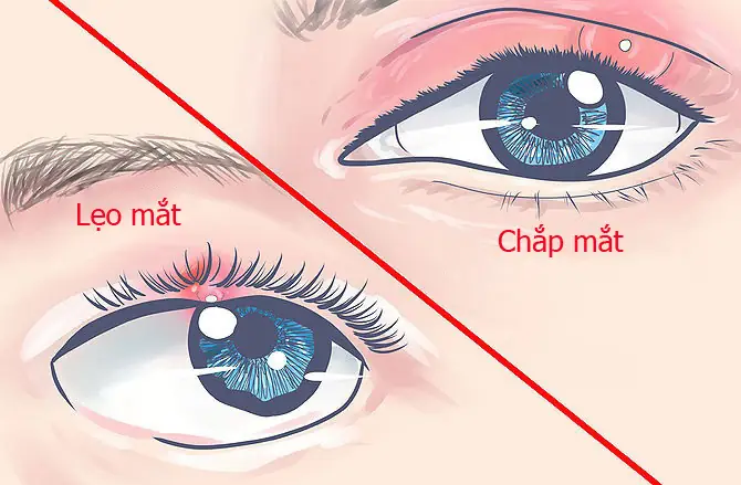 Khi Bị Chắp Lẹo Các Em Không Nên