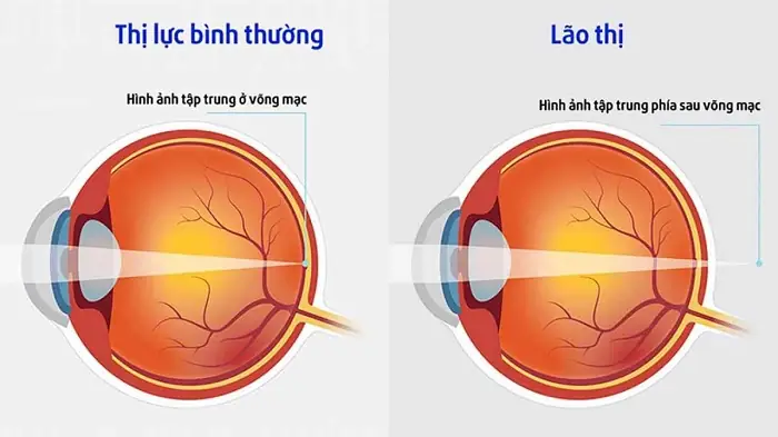 Khoảng Cực Cận Của Mắt Lão Là Gì?