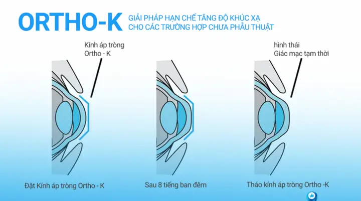 Kính Áp Tròng Ban Đêm Ortho K Giá Bao Nhiêu? So Sánh Chi Tiết 5 Thương Hiệu Phổ Biến