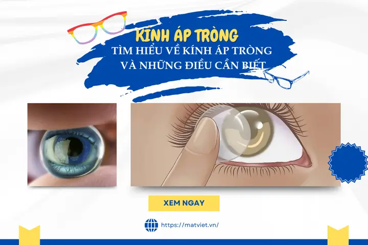 Kính Áp Tròng Còn Gọi Là Gì? Tổng Hợp Từ A-z Về Loại Kính Đeo Trực Tiếp Trên Mắt