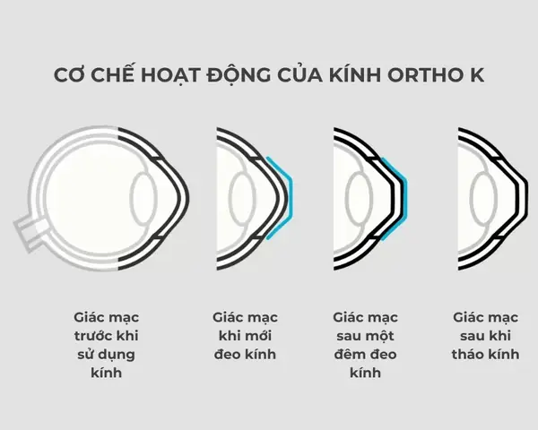 Kính Áp Trong Ortho-k Là Gì? Cách Hoạt Động Và Ứng Dụng Thực Tế