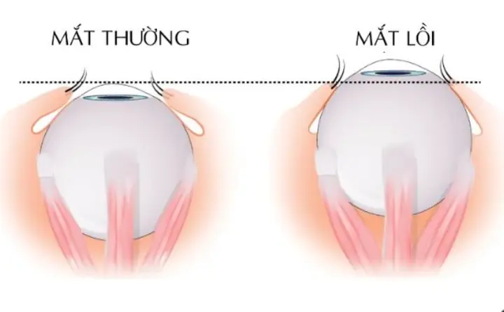 Làm Thế Nào Để Mắt Không Bị Lồi