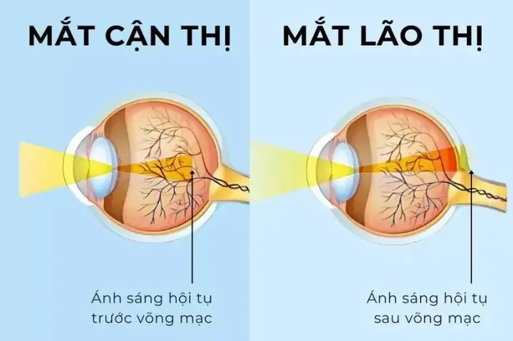 Lão Thị Và Cận Thị Là Gì? Phân Biệt Và Cách Xử Lý