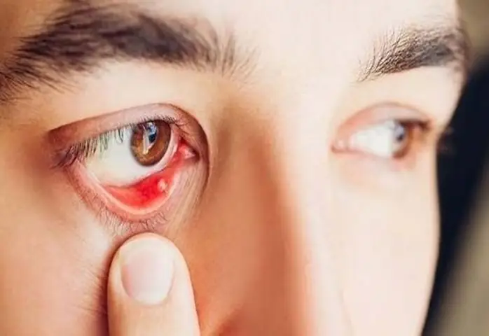 Lấy Sạn Vôi Trong Mắt Bao Nhiêu Tiền