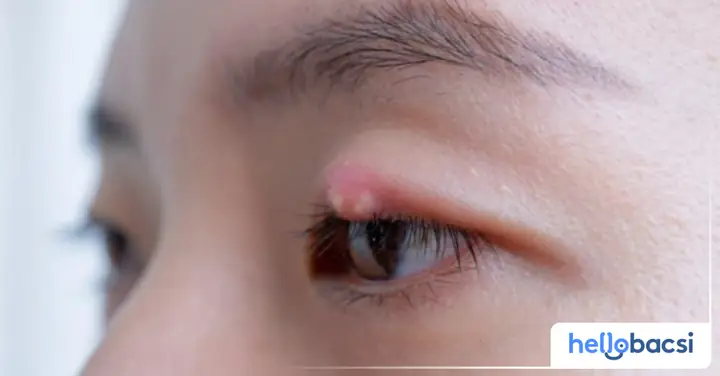 Lên Lẹo Mắt Kiêng Ăn Gì? Hướng Dẫn Chi Tiết Từ A Đến Z