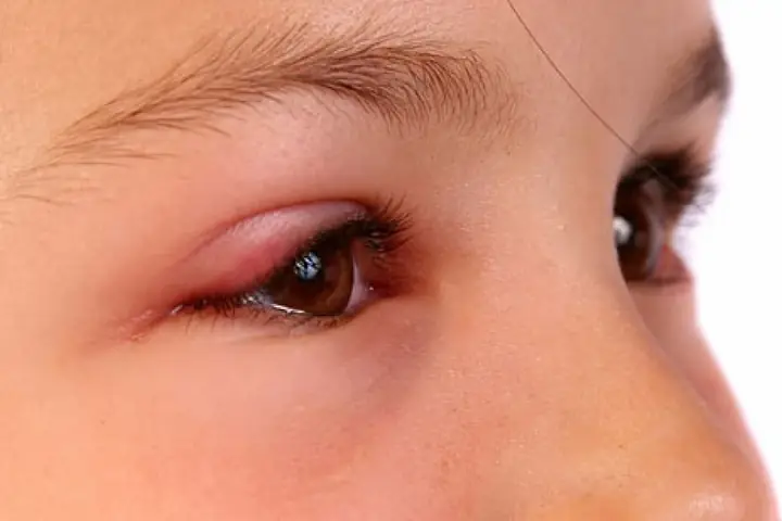 Léo Mắt Lâu Ngày Không Khỏi: Nguyên Nhân Và Cách Xử Lý