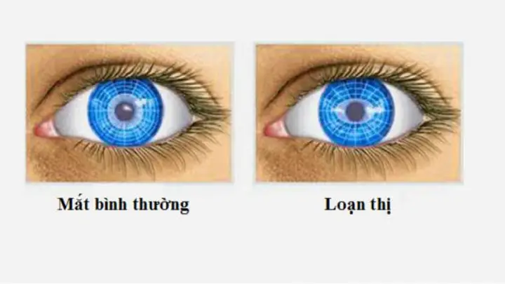 Loạn Thị Có Làm Tăng Độ Cận Không?