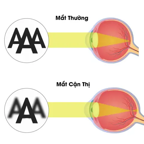 Loạn Thị Với Cận Thị Cái Nào Nặng Hơn