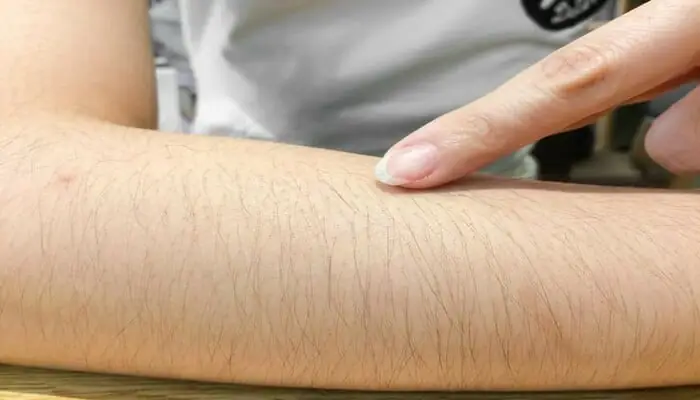 Lông Tay Nhiều Ở Nữ: Nguyên Nhân Và Cách Xử Lý Hiệu Quả