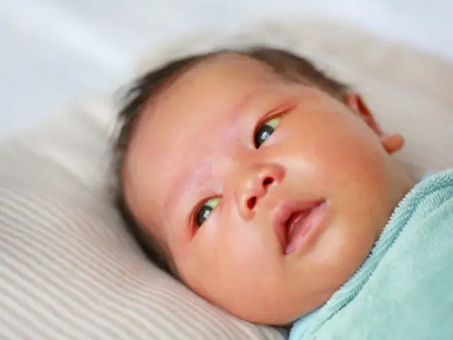 Lòng Trắng Mắt Bị Vàng Là Bệnh Gì: Nguyên Nhân & Cách Xử Lý Toàn Diện