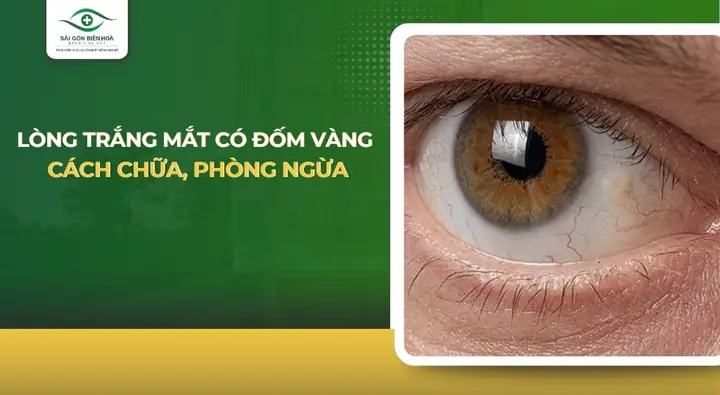 Lòng Trắng Mắt Có Đốm Vàng Là Gì?