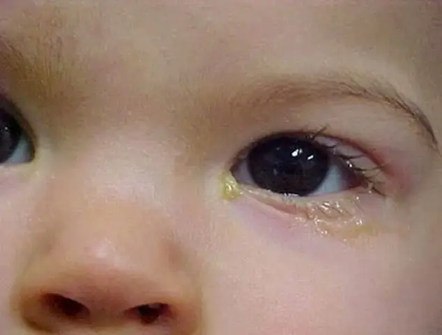 Mắt Bé Đổ Ghèn Khi Ngủ Dậy: Nguyên Nhân Và Cách Xử Lý Toàn Diện