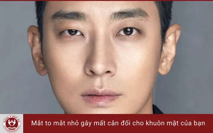 Mắt Bên To Bên Nhỏ: Nguyên Nhân, Đánh Giá Và Cách Xử Lý