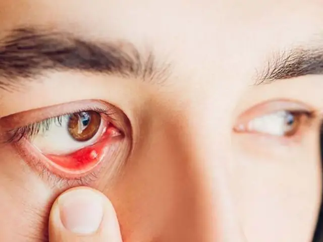 Mắt Bị Cộm Và Rát: Nguyên Nhân, Triệu Chứng Và Cách Xử Lý Hiệu Quả
