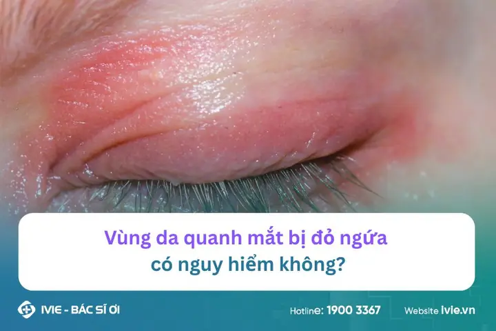 Vùng Da Quanh Mắt Bị Đỏ Ngứa: Nguyên Nhân & Cách Xử Lý Tại Nhà