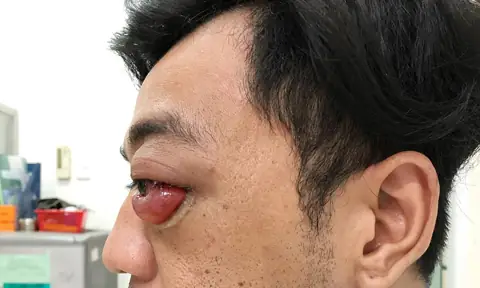 Mắt Bị Lồi Ra Ngoài: Nguyên Nhân, Triệu Chứng & Cách Xử Lý