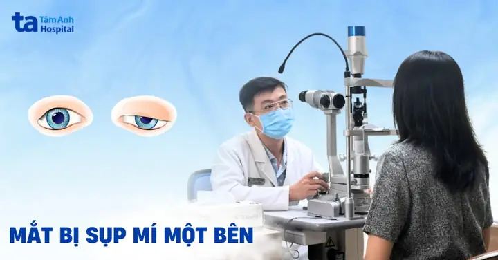 Sụp Mí 1 Bên: Nguyên Nhân & Các Phương Pháp Cải Thiện Hiệu Quả