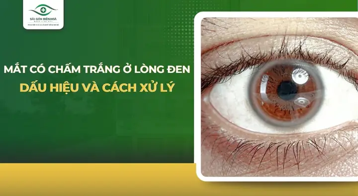 Mắt Bị Trắng Ở Lòng Đen Là Gì? Nguyên Nhân Và Khuyến Cáo