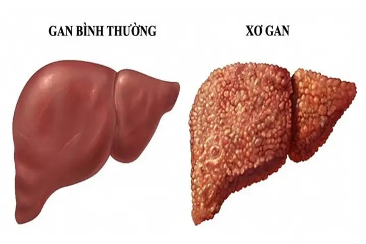Mắt Bị Vàng Là Triệu Chứng Của Bệnh Gì? Nguyên Nhân & Cách Xử Lý