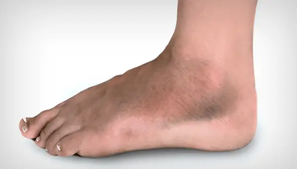 Mắt Cá Chân Bị Thâm Và Chai: Nguyên Nhân Và Cách Khắc Phục Hiệu Quả
