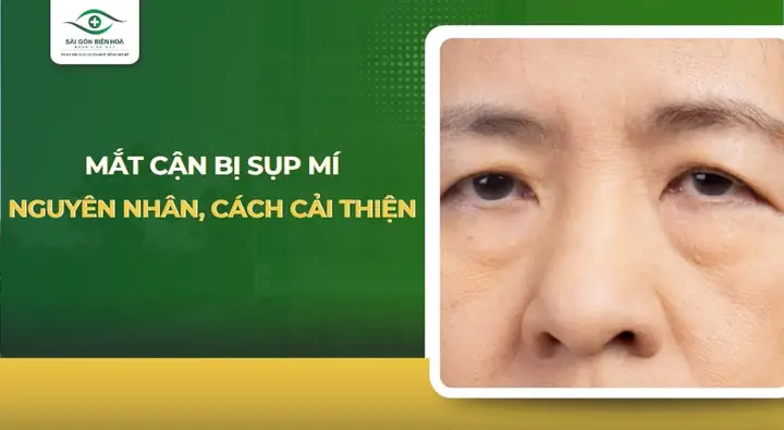 Mắt Cận Bị Sụp Mí: Nguyên Nhân Thực Tế Và Cách Khắc Phục Hiệu Quả