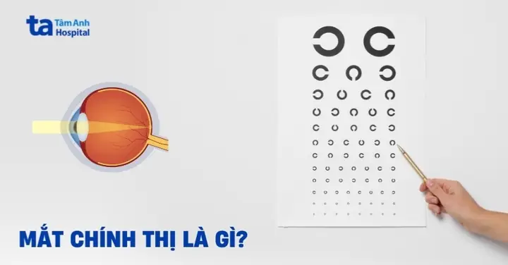 Mắt Chính Thị Là Gì? Phân Biệt Với Cận Thị, Viễn Thị
