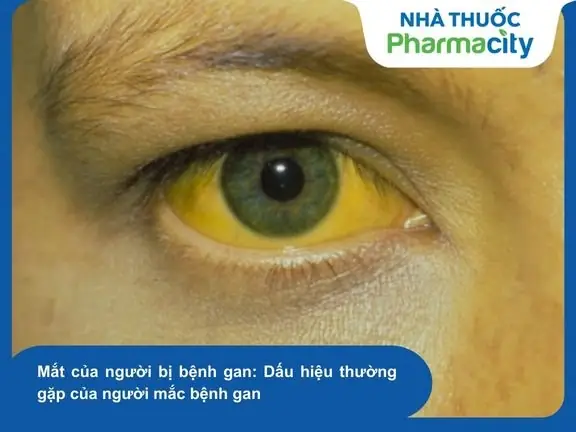 Mắt Của Người Bị Bệnh Gan: 6 Dấu Hiệu Cảnh Báo Sớm Cần Biết