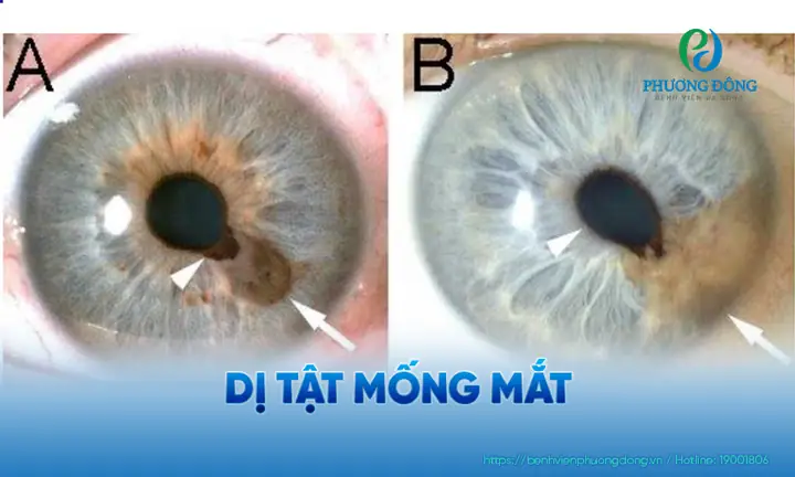Mắt Không Có Tật Là Mắt Như Thế Nào