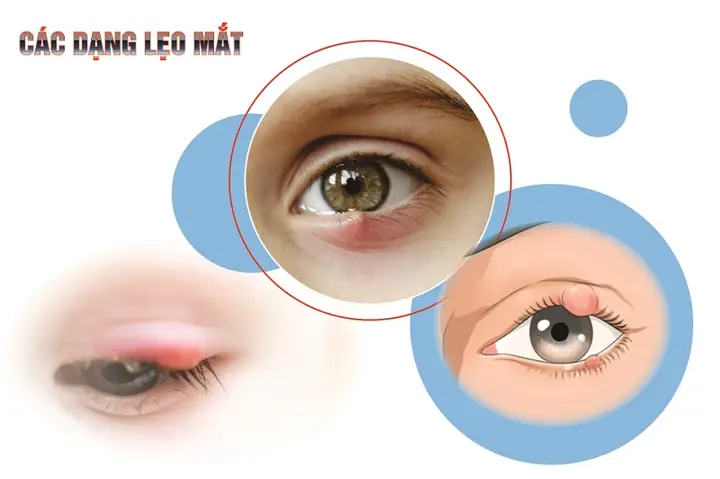 Mắt Lẹo Có Lây Không? Giải Đáp Chi Tiết Từ Chuyên Gia