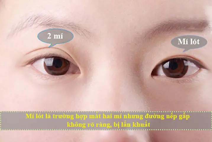 Mắt Mí Lót Tiếng Anh Là Gì? Các Phương Pháp Phổ Biến