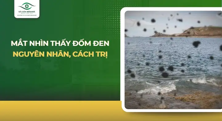 Mắt Nhìn Thấy Đốm Đen (ruồi Bay): Nguyên Nhân, Nguy Hiểm & Cách Xử Lý