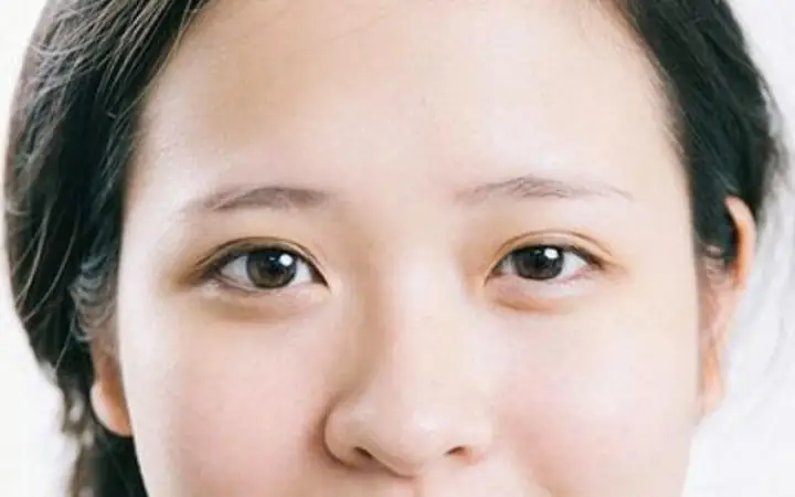 Mắt To Mắt Nhỏ Khi Cười: Hiện Tượng Thường Gặp Và Những Điều Cần Biết