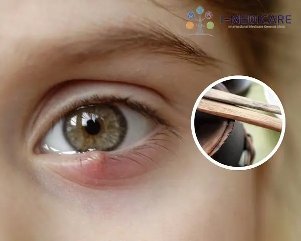 Chữa Léo Mắt Bằng Đũa Cả: Phương Pháp Dân Gian Có Thật Sự Hiệu Quả?
