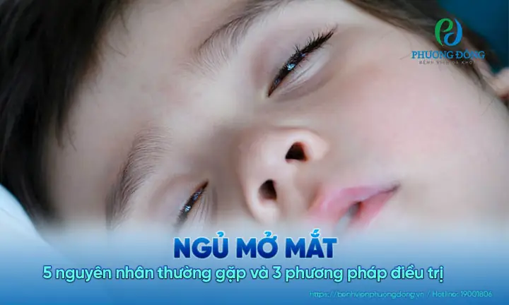Mẹo Chữa Ngủ Mở Mắt Hiệu Quả Và An Toàn