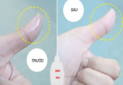 Mẹo Khi Bị Dính Keo 502: Cách Xử Lý Nhanh Chóng Và An Toàn