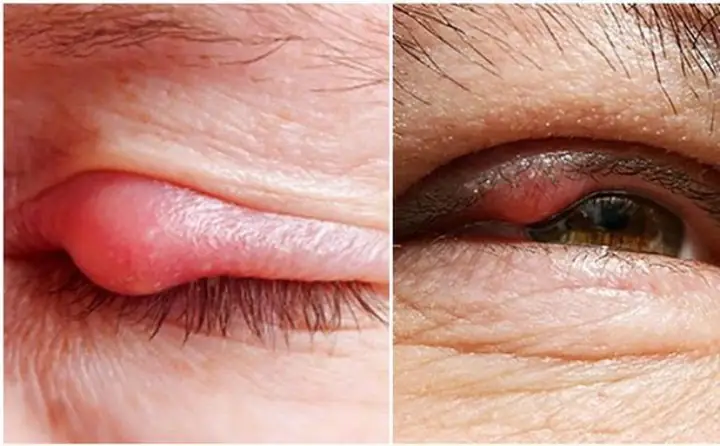 Mí Mắt Bị Đau Nhức: Nguyên Nhân Và Cách Khắc Phục Hiệu Quả