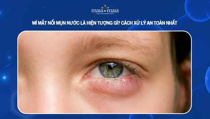 Mí Mắt Nổi Mụn Nước Nhỏ: Nguyên Nhân, Cách Xử Lý Và Phòng Tránh Hiệu Quả