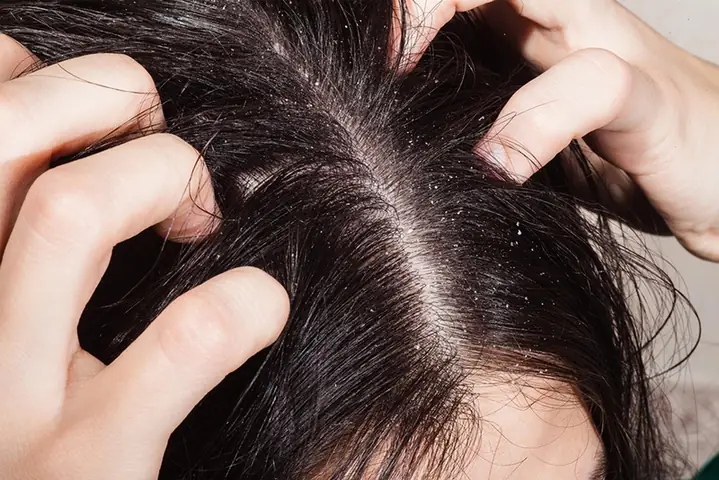 Tại Sao Da Đầu Thường Xuyên Ngứa? Nguyên Nhân & Cách Khắc Phục Hiệu Quả