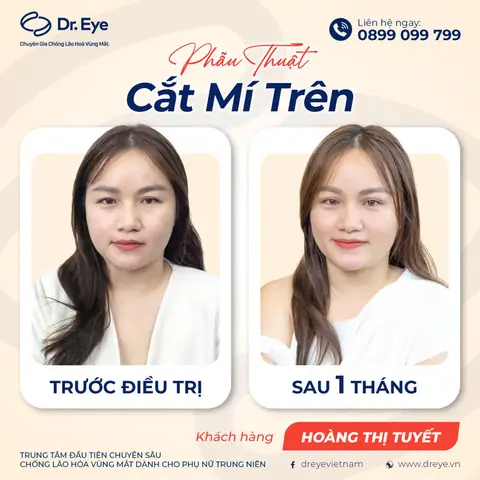 Mổ Mắt Bao Lâu Thì Được Nối Mi? Thời Gian Chuẩn Và Lưu Ý Quan Trọng