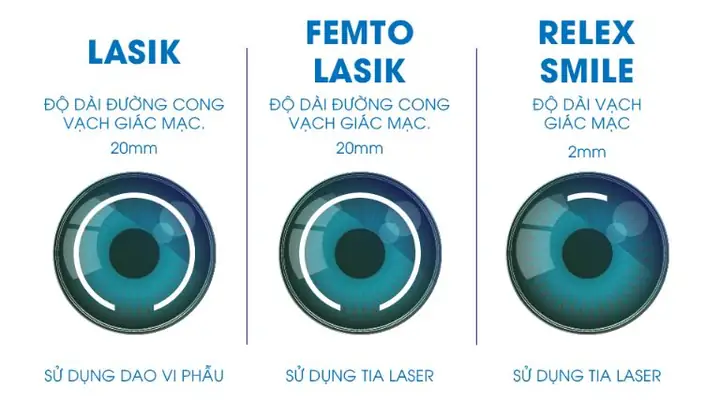 Top 5 Bệnh Viện Mổ Mắt Công Nghệ Smile Uy Tín Nhất Hiện Nay