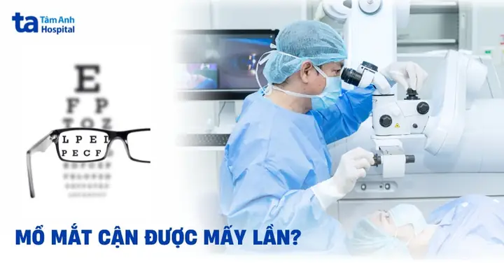 Mổ Mắt Cận Được Mấy Lần? Điều Kiện, Hiệu Quả & Lưu Ý Toàn Diện