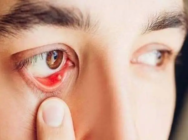 Mọc Mụn Trong Mắt Phải Làm Sao? Hướng Dẫn Xử Lý An Toàn Và Khi Nào Cần Đi Khám
