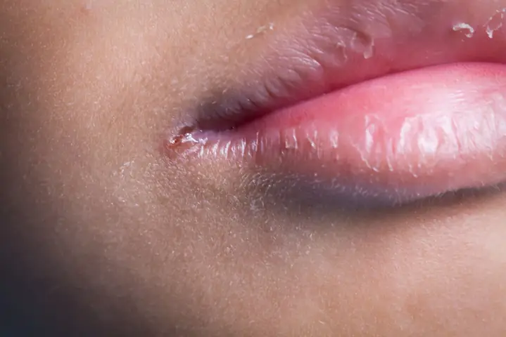 Môi Hay Bị Khô Là Bệnh Gì? Nguyên Nhân Và Cách Khắc Phục