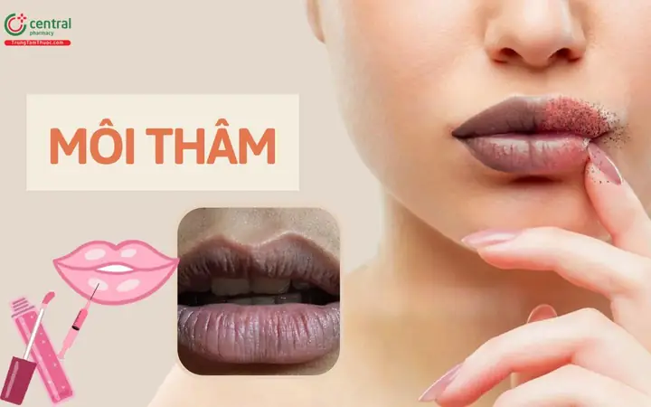 Môi Thâm Là Biểu Hiện Bệnh Gì? Nguyên Nhân Và Khuyến Nghị Y Tế