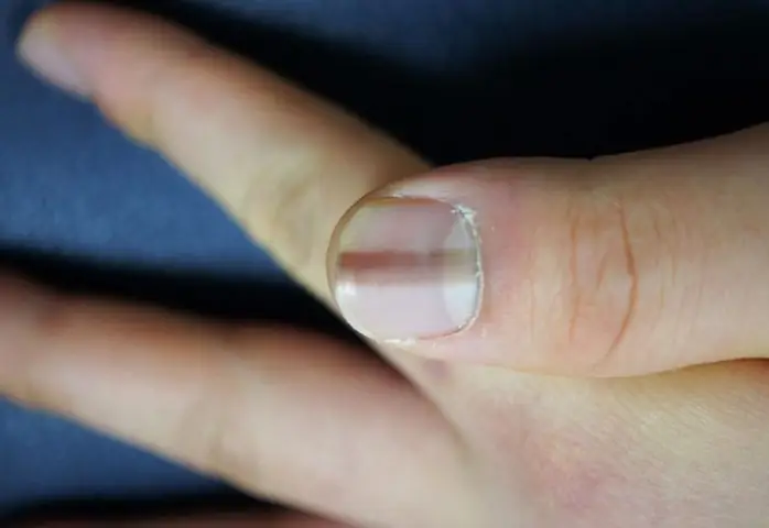 Móng Tay Đen Là Bệnh Gì? Nguyên Nhân Và Cách Xử Lý