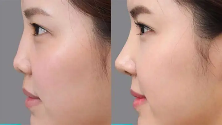 Mũi Tẹt Có Thực Sự Xấu Không? Phân Tích Toàn Diện Từ Thẩm Mỹ, Phong Thủy Đến Sức Khỏe