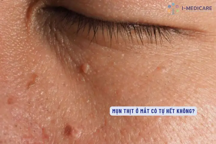 Mụn Thịt Quanh Mắt Có Nguy Hiểm Không