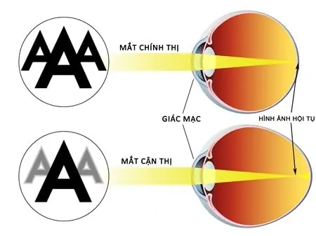 Cận Thị Đeo Kính Gì? So Sánh Chi Tiết Kính Gọng & Tiếp Xúc