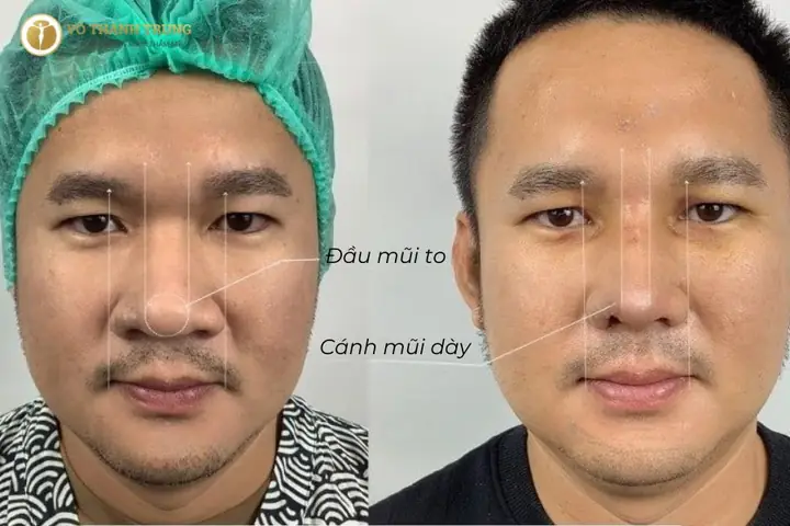 Người Có Cánh Mũi To: Từ Phẫu Thuật Thẩm Mỹ Đến Phong Thủy