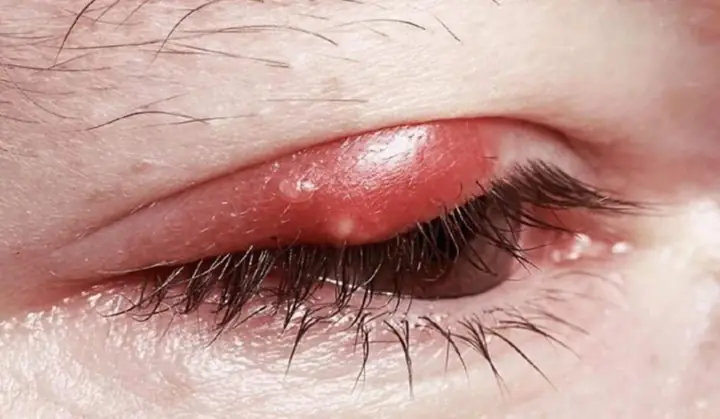 Nổi Mụn Trắng Ở Mí Mắt Trên: Nguyên Nhân Và Cách Xử Lý